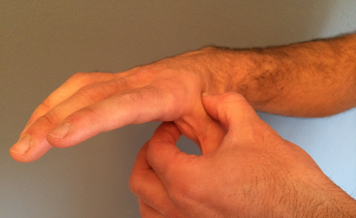 Rizartrosis o artrosis de pulgar - Ortopedia3D